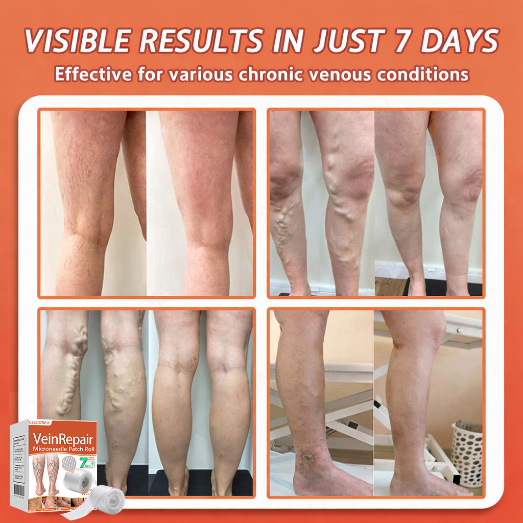 🧚🧚Last Day Promotion 50% OFF - Celsiora® Vein Ease Microneedle Care Patch