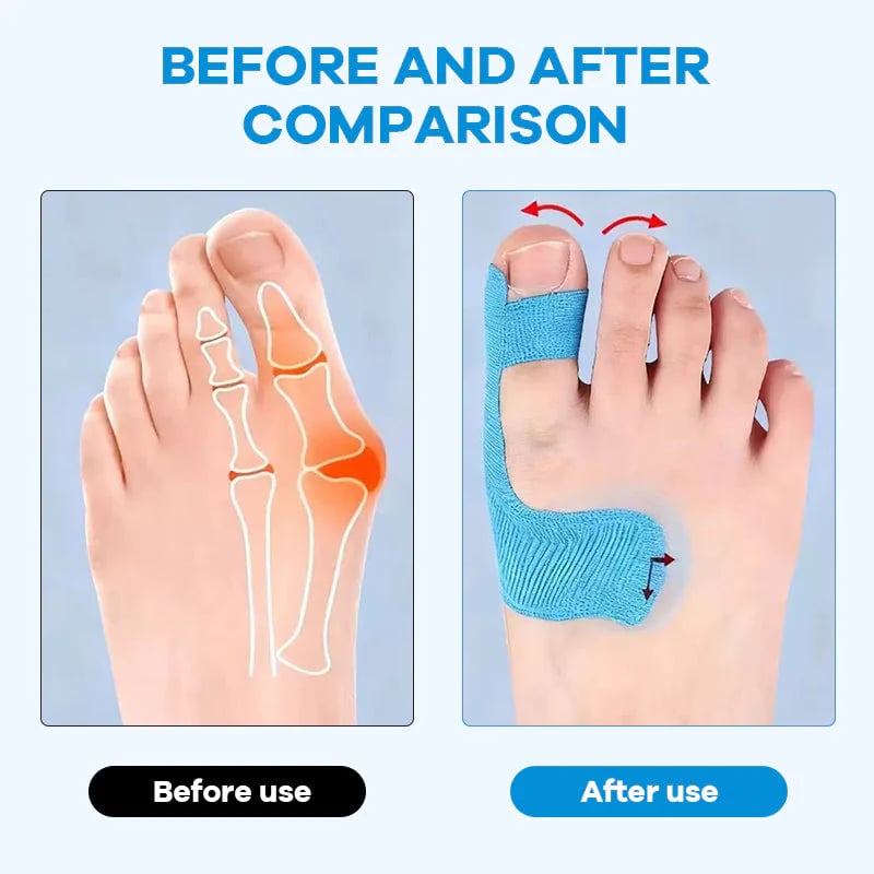 🔥💞LAST DAY 75% OFF ✨Bunion Relief Toe Correction Wrap