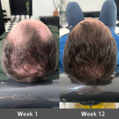 👨‍⚕️👨‍⚕️ Official Store | 🔥Beddys® Highly Effective Biotin & Rosemary Hair Growth Serum — Visibly fills thinning areas & receding hairlines (🔥 Limited-Time Offer, ⏳ Last 30 Minutes)