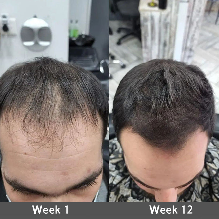 👨‍⚕️👨‍⚕️ Official Store | 🔥Beddys® Highly Effective Biotin & Rosemary Hair Growth Serum — Visibly fills thinning areas & receding hairlines (🔥 Limited-Time Offer, ⏳ Last 30 Minutes)