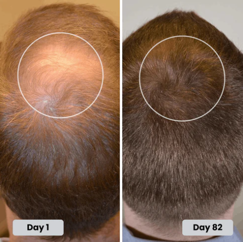 🔥HOT SALE 50% OFF🔥Red light hair growth CAP — Regrow Thicker Hair in 90 Days