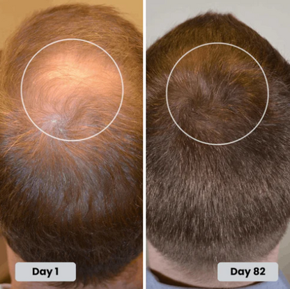 🔥HOT SALE 50% OFF🔥Red light hair growth CAP — Regrow Thicker Hair in 90 Days