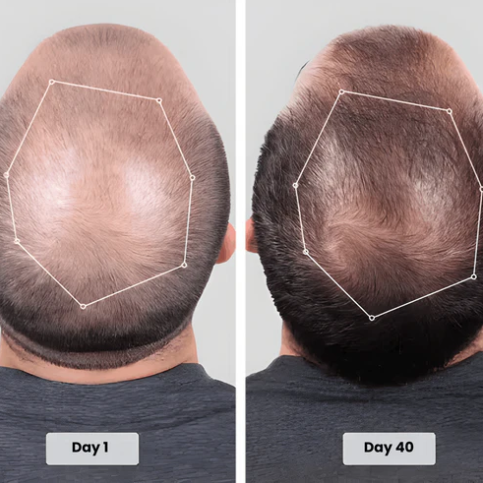 🔥HOT SALE 50% OFF🔥Red light hair growth CAP — Regrow Thicker Hair in 90 Days
