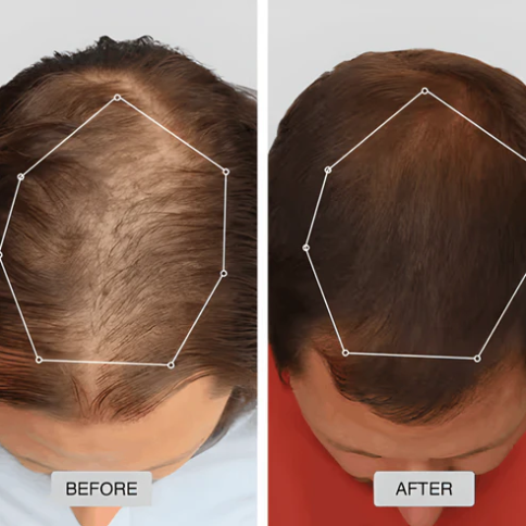 🔥HOT SALE 50% OFF🔥Red light hair growth CAP — Regrow Thicker Hair in 90 Days