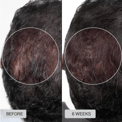 🔥HOT SALE 50% OFF🔥Red light hair growth CAP — Regrow Thicker Hair in 90 Days